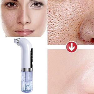 PorePro- Blackhead Remover